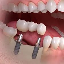 most-porcelanowy-na-2-implantach