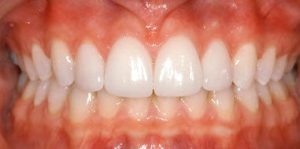 po-wykonaniu-licowek2