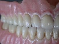 proteza-calkowita-gorna-dolna