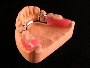 proteza-szkieletwowa-metalowa