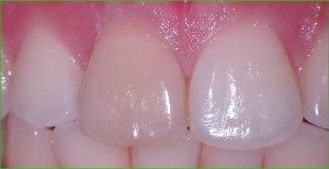 przebarwiona-gorna-jedynka