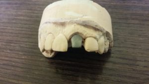 wklad-na-modelu-gipsowym