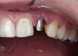 wklad-zacementowany-w-korzeniu